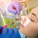 Endoskopik sinüs cerrahisi