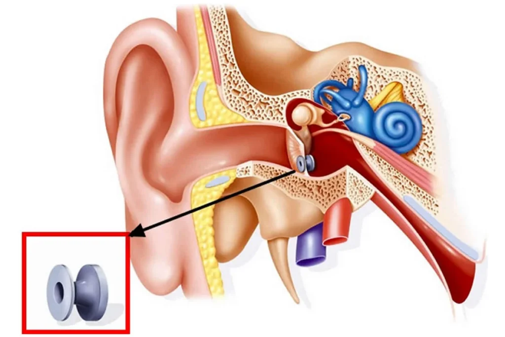 Kulak tüpü takılması