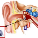 Kulak tüpü takılması