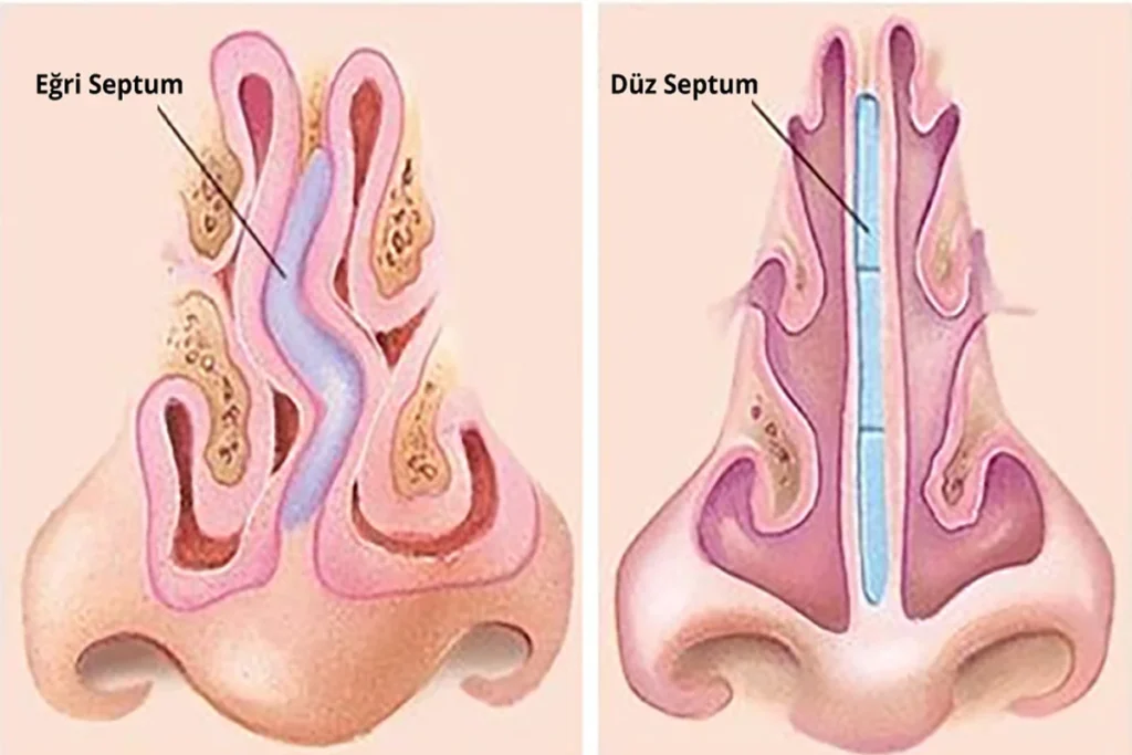 septum deviasyonu