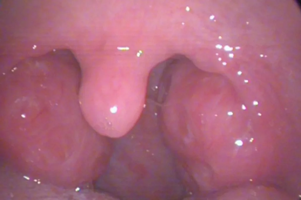 Bademcik küçültme ameliyatı