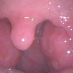 Bademcik küçültme ameliyatı